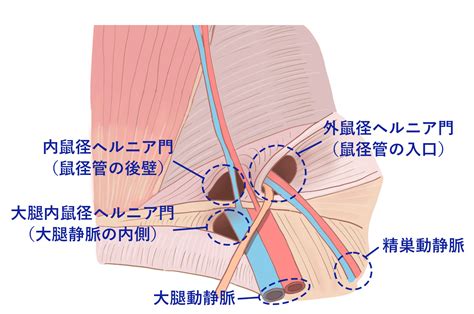 鼠径ヘルニア（外鼠径ヘルニア、内鼠径ヘルニア、大。